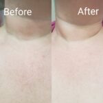 Customer Before and After result using Soke Chest treatment patch