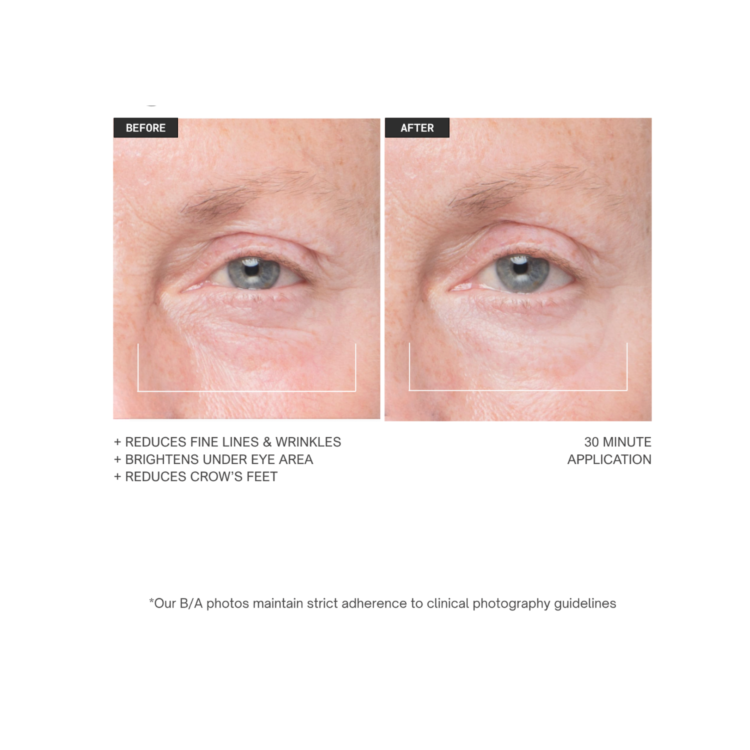 Soke hydrogel eye treatment clinical before and after showing improvement in under-eye wrinkles and crow’s feet after one 30-minute treatment