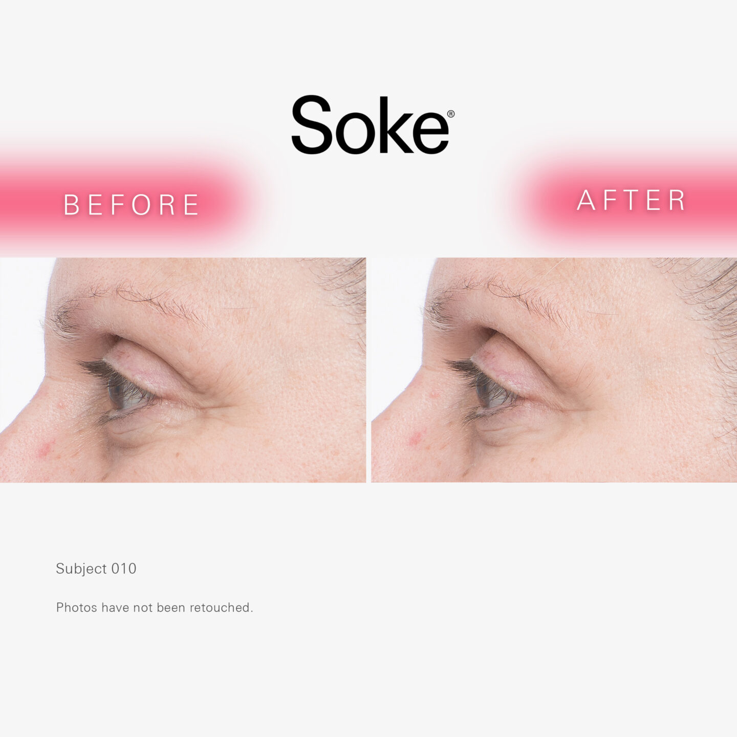 Real, unedited photos taken before and after using hydrogel anti-aging eye treatment patches by Soke Beauty