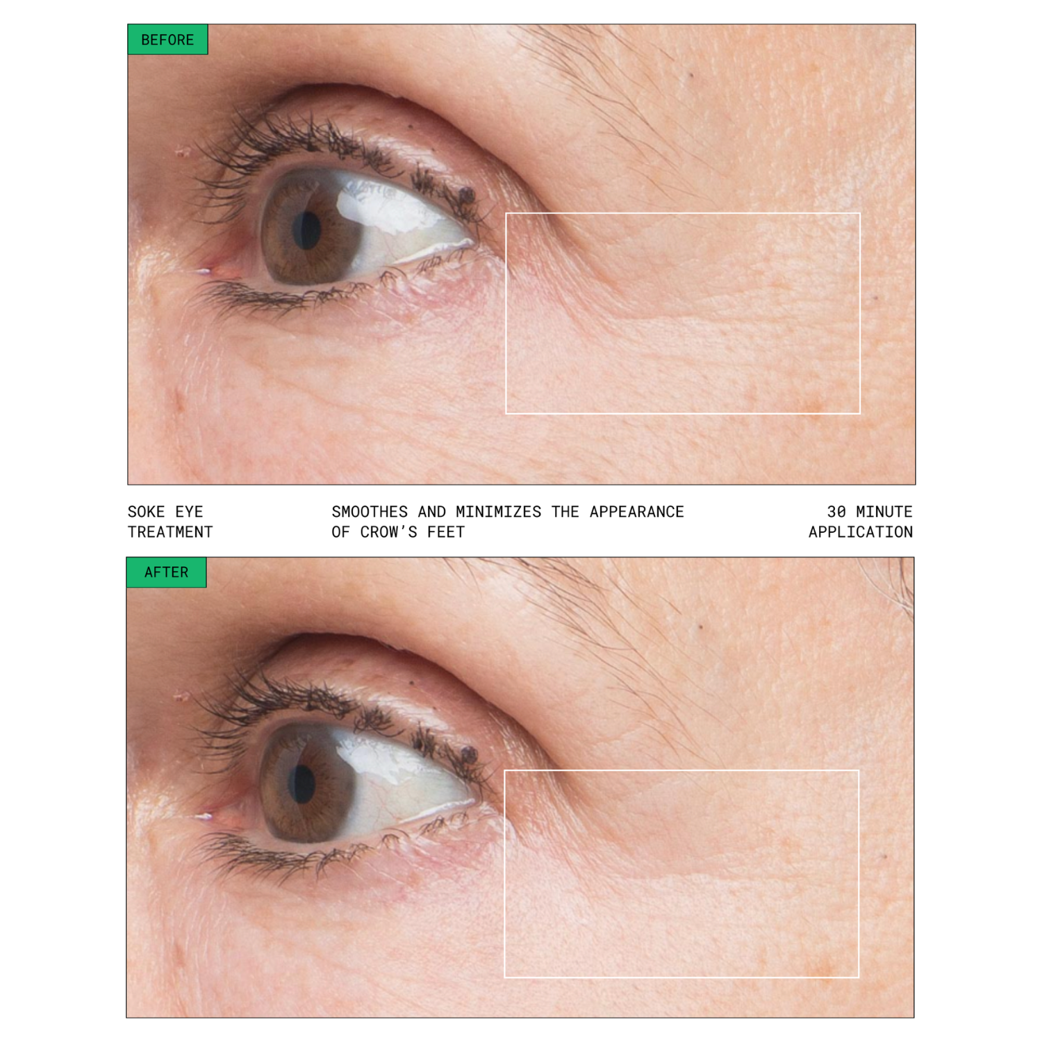 Soke hydrogel eye treatment before and after showing visible improvement in crow’s feet and fine lines after one 30-minute treatment